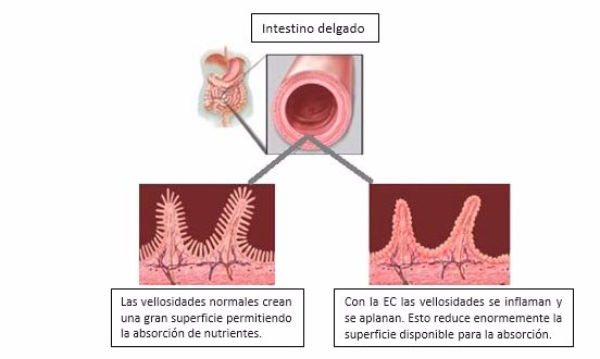 intestino dañado por enfermedad celíaca