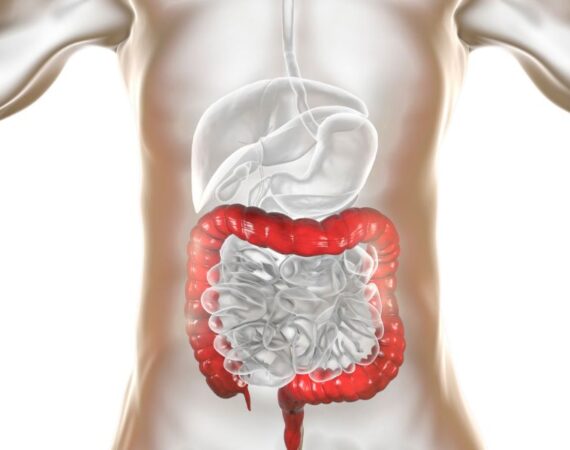 Sobrecrecimiento bacteriano (SIBO) mi experiencia