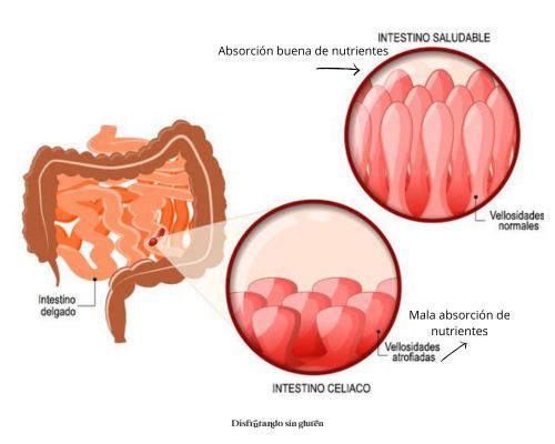 Com están las vellosidades intestinales en celiaquía.